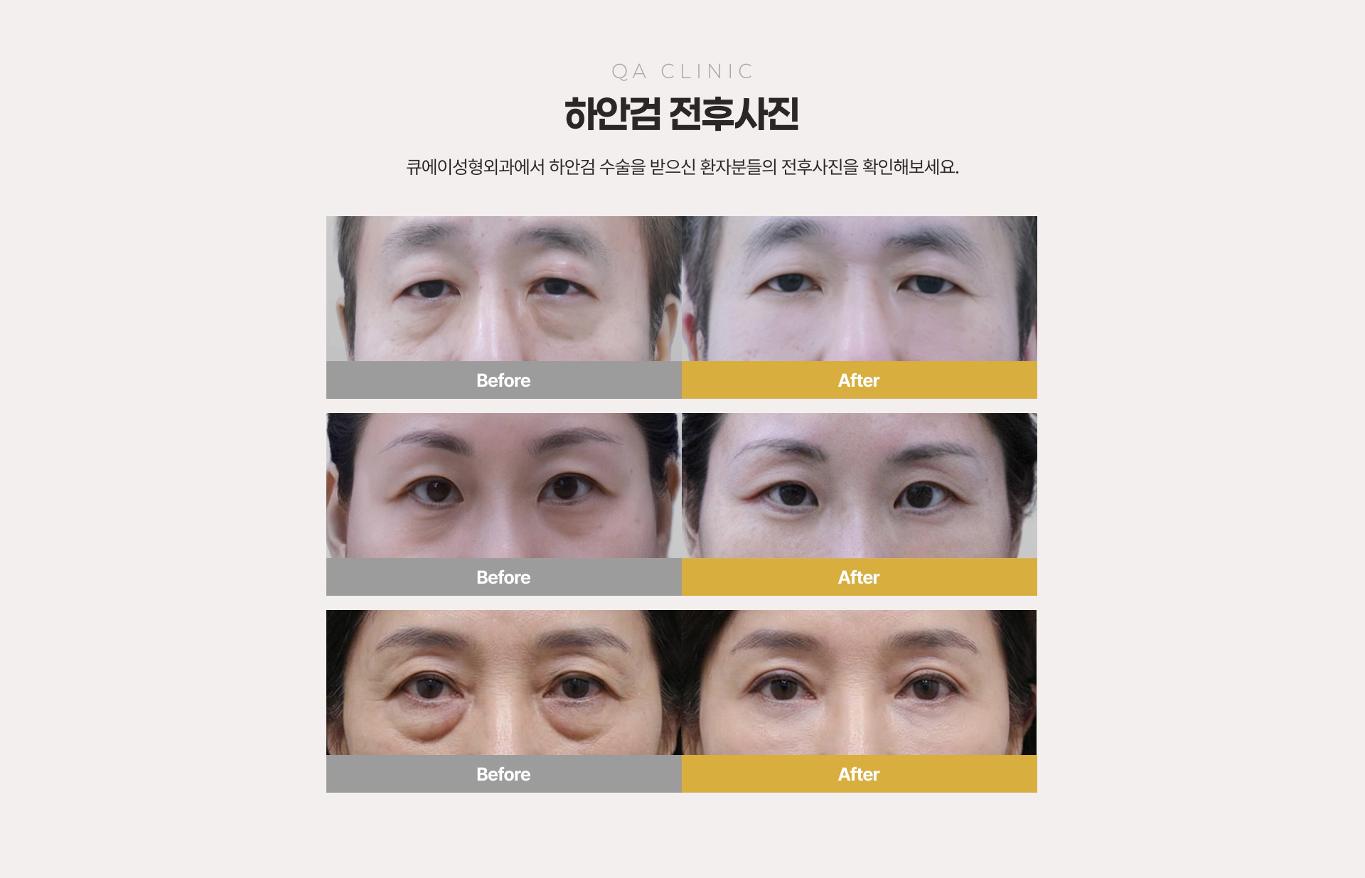 QA CLINIC 하안검 전후사진 Before & After