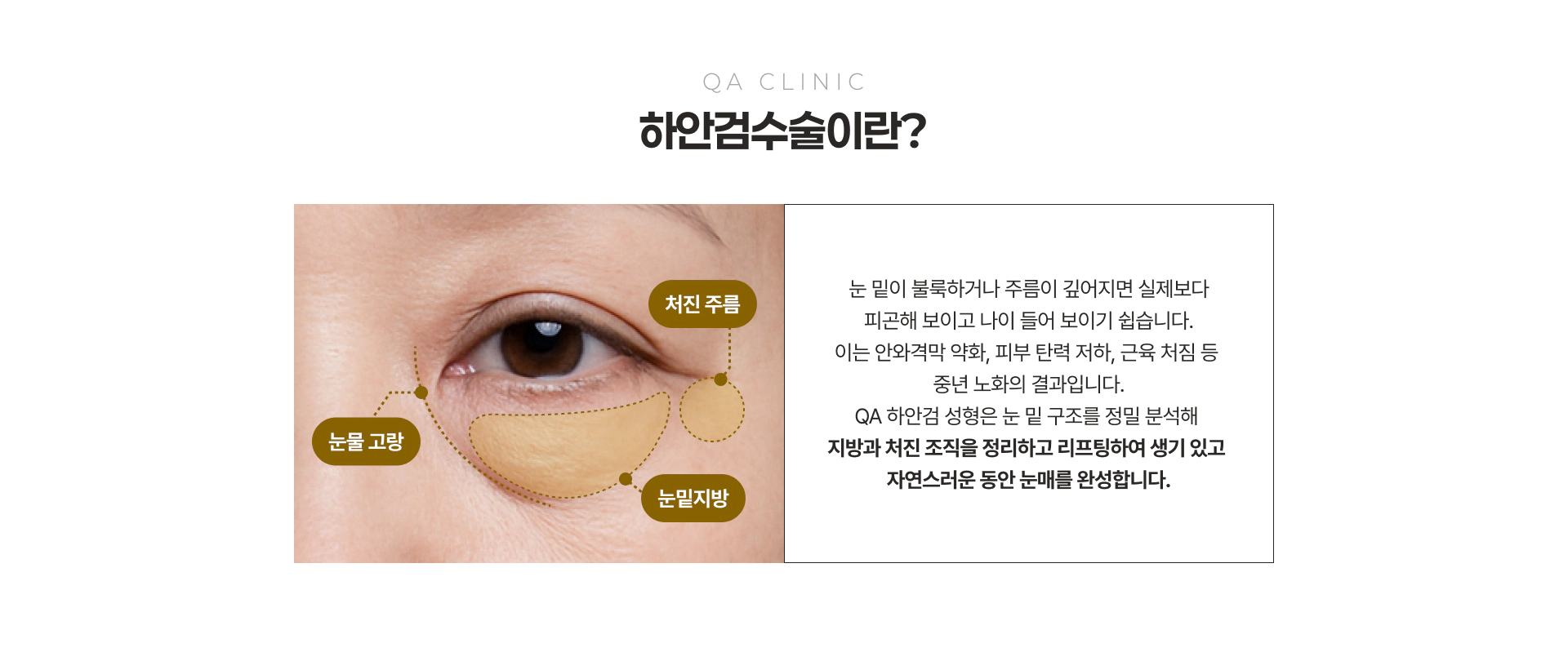 QA CLINIC 하안검수술이란?