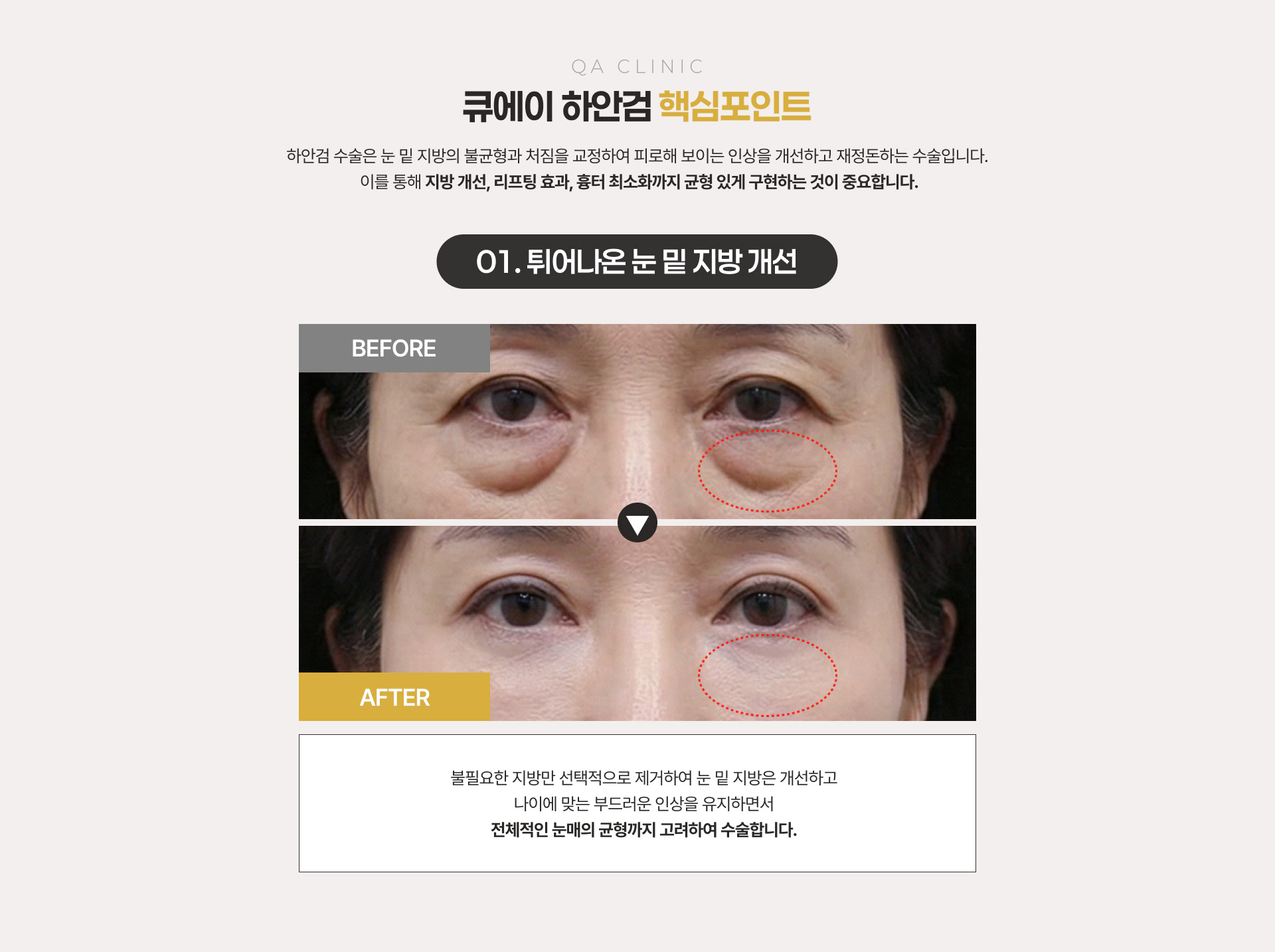 큐에이 하안검 핵심포인트 01 튀어나온 눈 밑 지방 개선