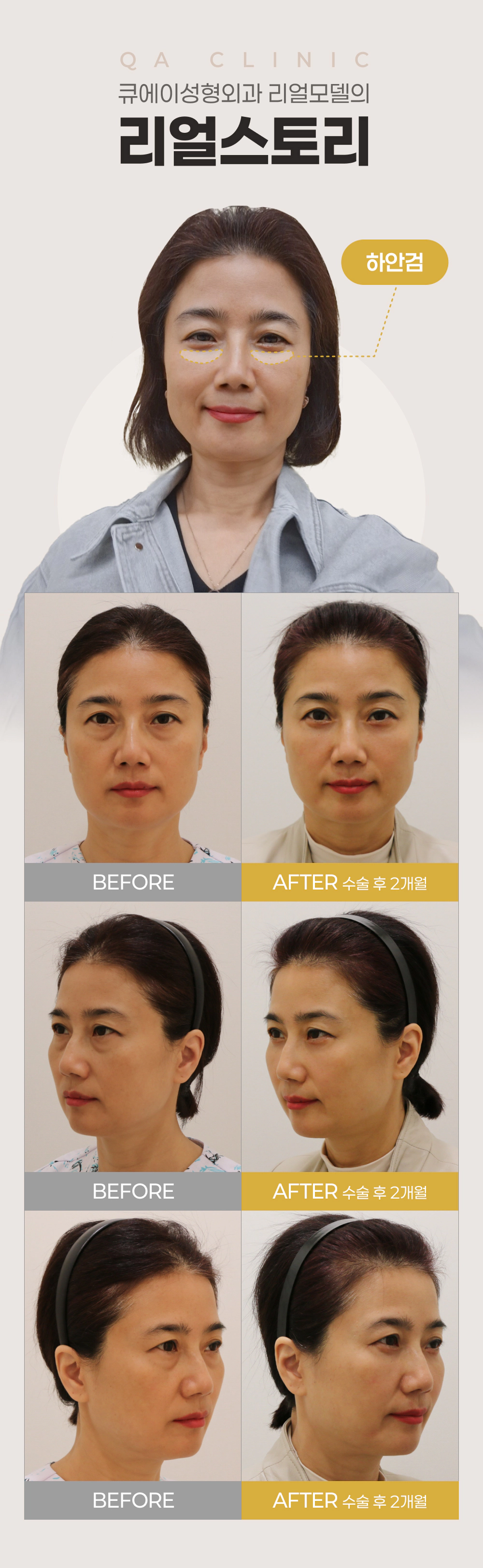 큐에이성형외과 리얼모델의 리얼스토리 하안검 BEFORE AFTER 수술 후 2개월