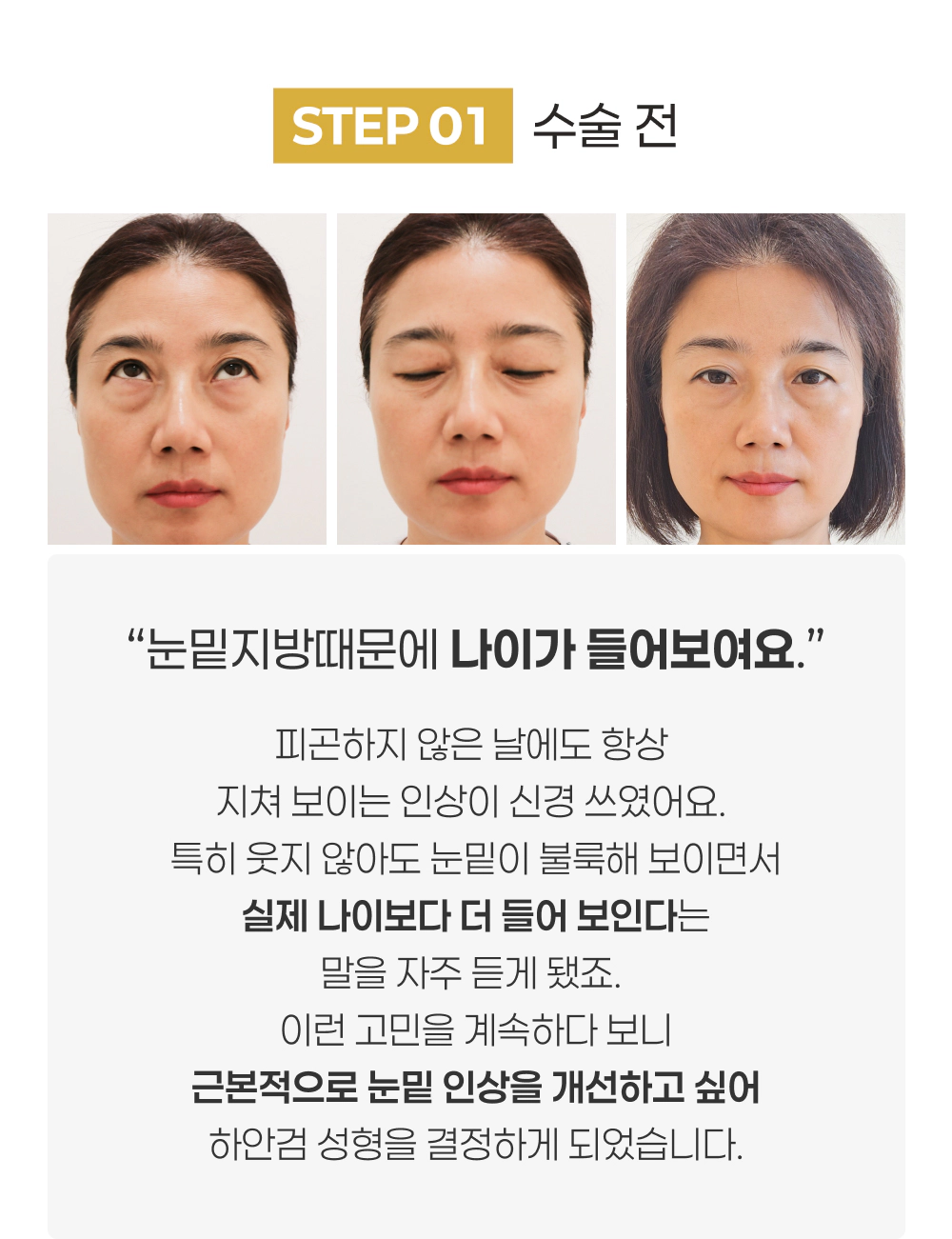 STEP 01 수술 전 눈밑지방때문에 나이가 들어보여요.
