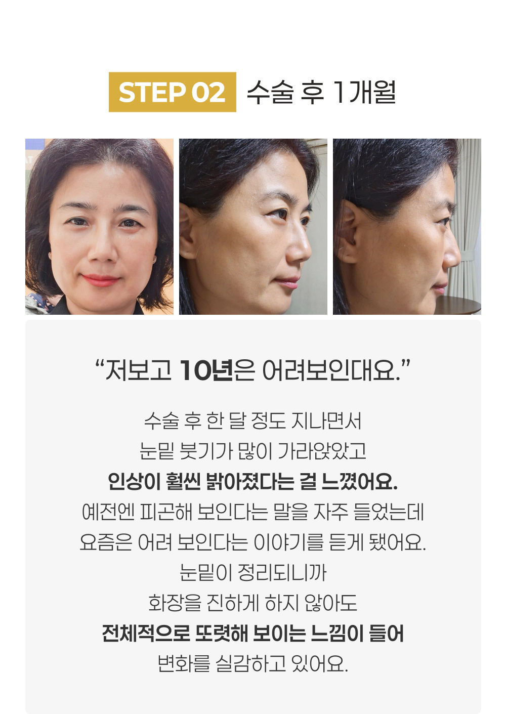 STEP 02 수술 후 1개월 저보고 10년은 어려보인대요.