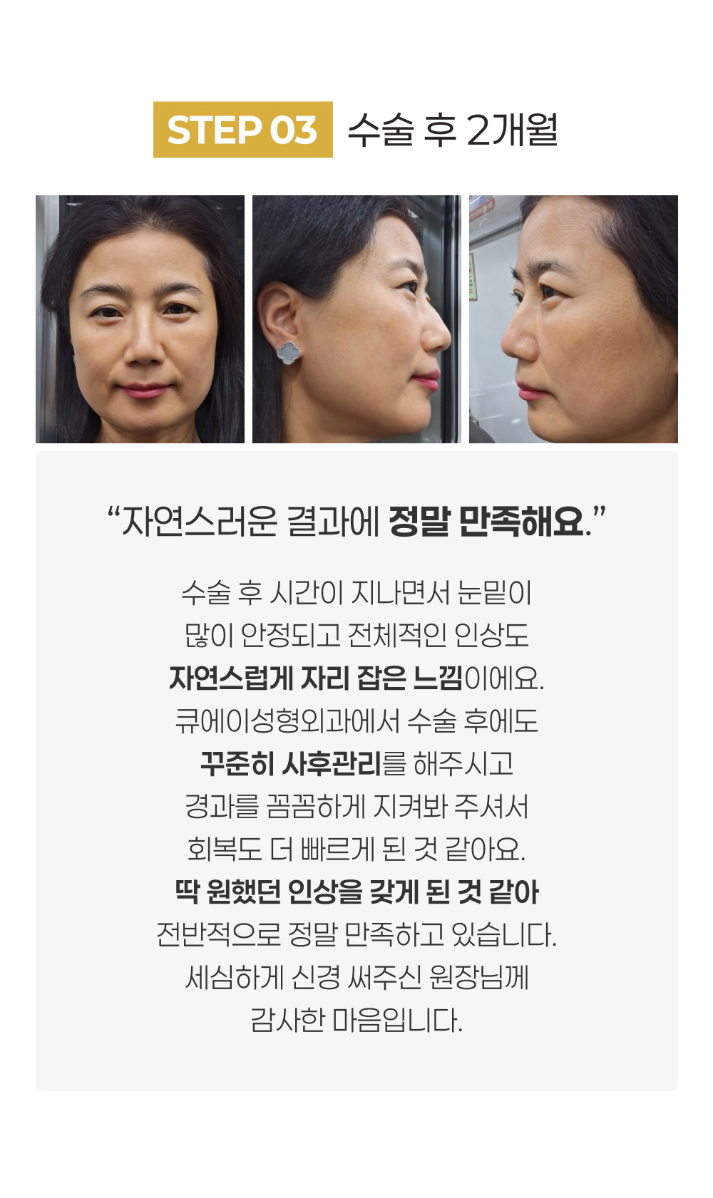 STEP 03 수술 후 2개월 자연스러운 결과에 정말 만족해요.