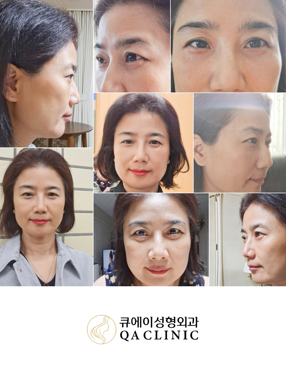 큐에이성형외과 리얼모델 수술 전후 사진 모음 QA CLINIC