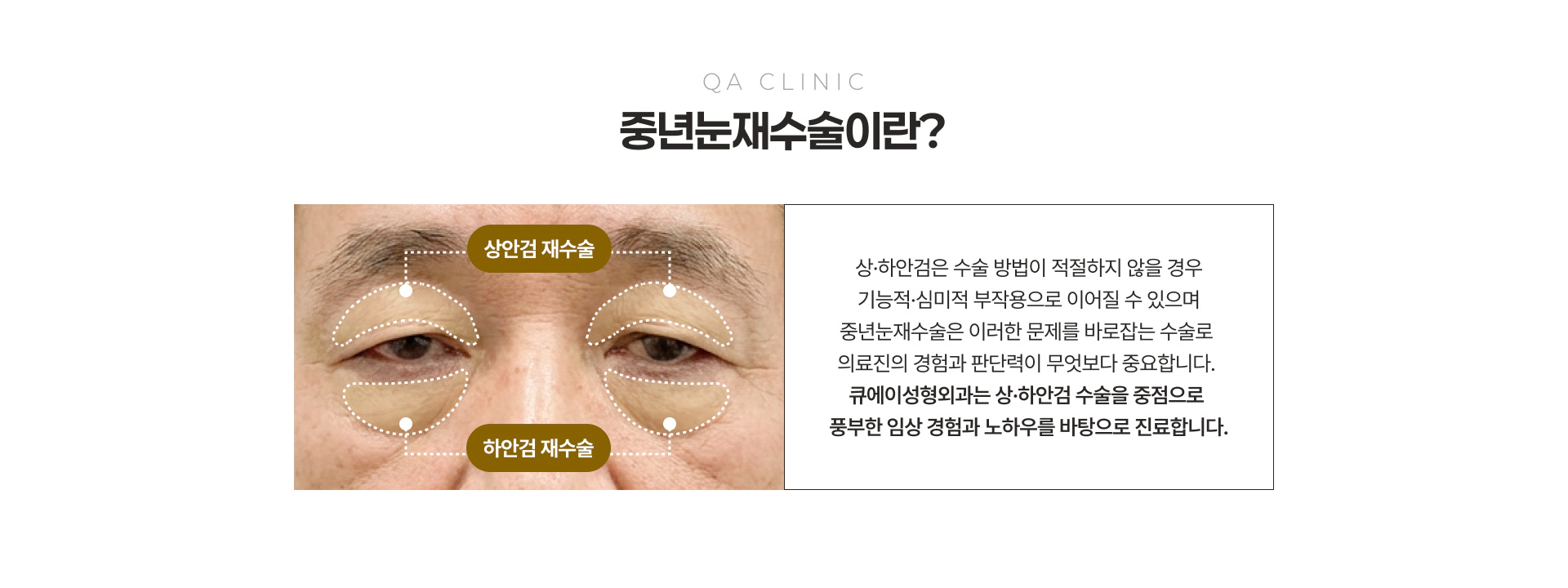QA CLINIC 중년눈재수술이란? 상안검 재수술 하안검 재수술