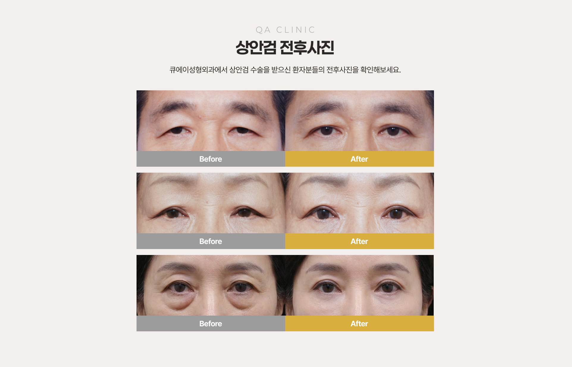 QA CLINIC 상안검 전후사진 Before & After