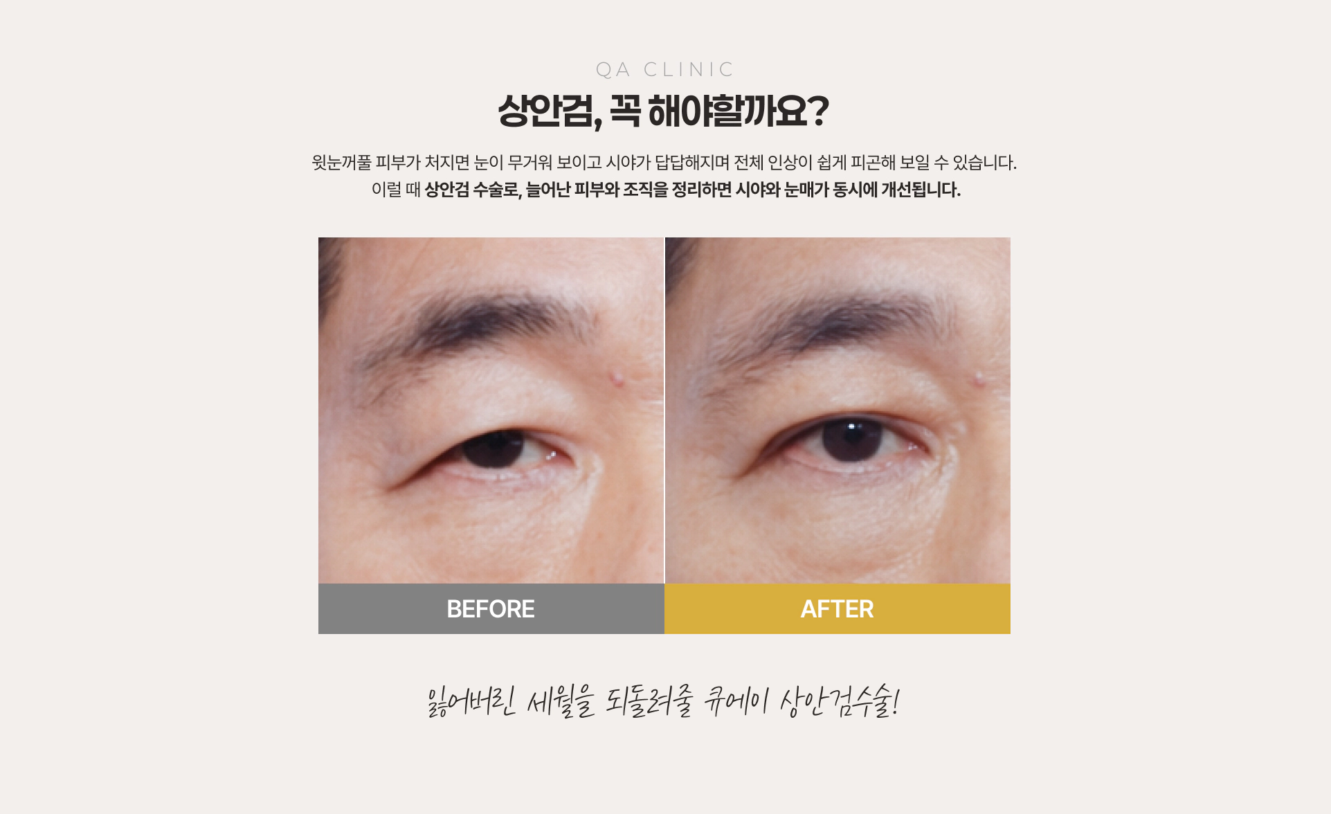 QA CLINIC 상안검, 꼭 해야할까요? 수술 전후 비교