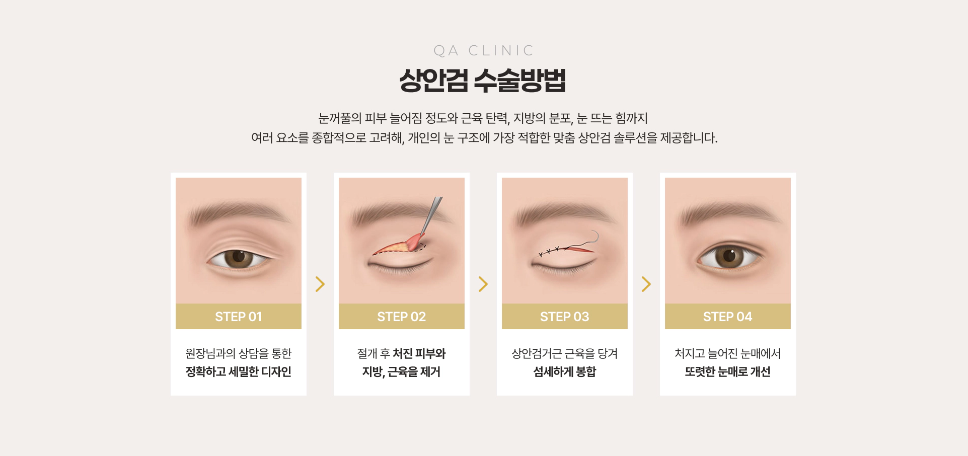 QA CLINIC 상안검 수술방법 STEP 01~04