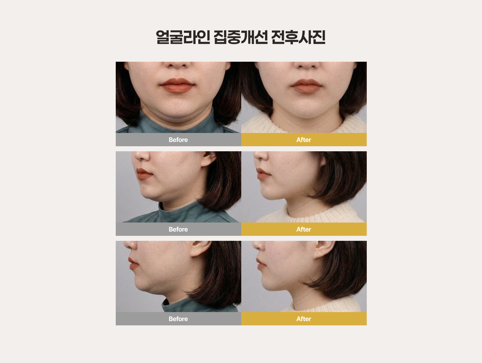 얼굴라인 집중개선 전후사진 Before After