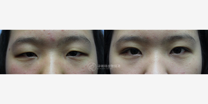 눈재수술3.jpg