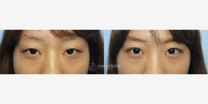 눈매교정비절개2.jpg