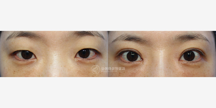뒷트임1.jpg