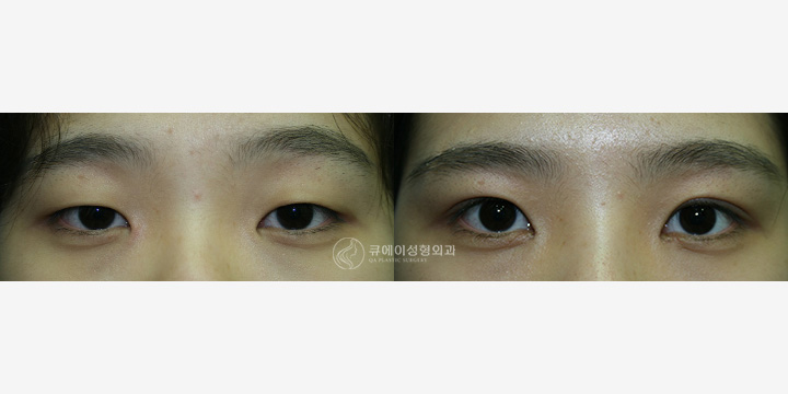 뒷트임2.jpg