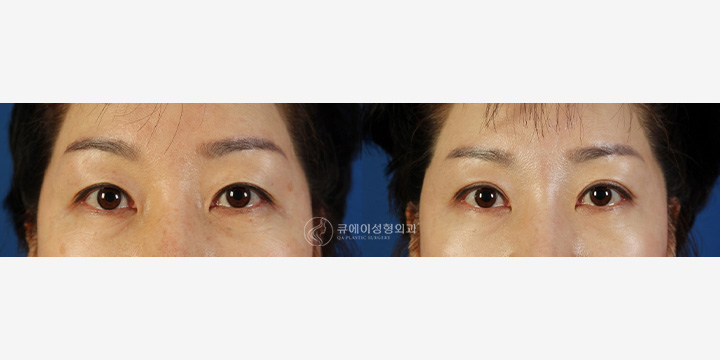 눈썹및거상술3.jpg