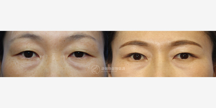 상안검3.jpg