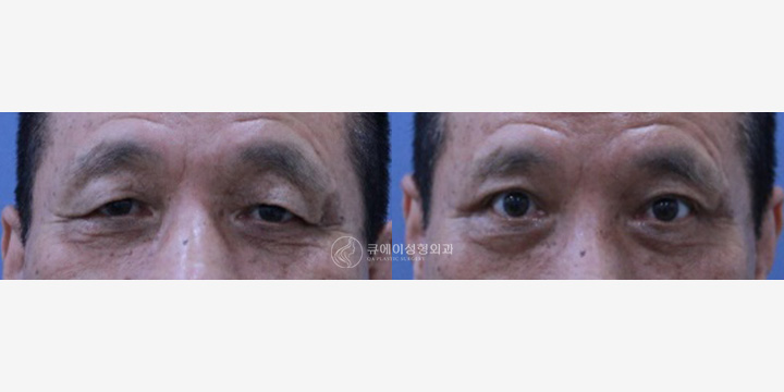 상안검4.jpg