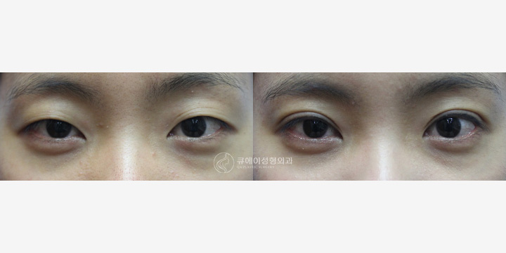 쌍꺼풀매몰1.jpg