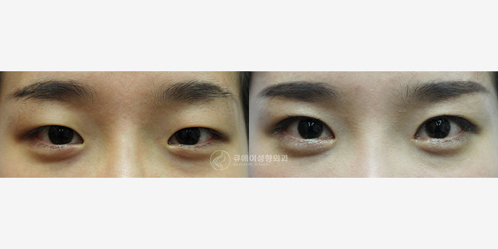 앞트임1.jpg