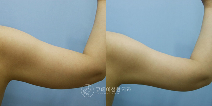 팔지방흡입1.jpg