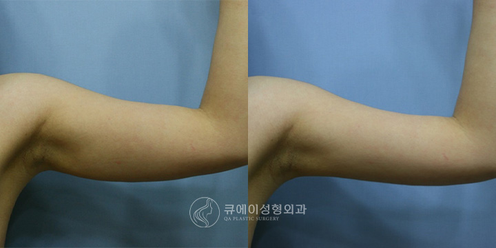 팔지방흡입2.jpg