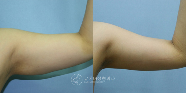 팔지방흡입3.jpg