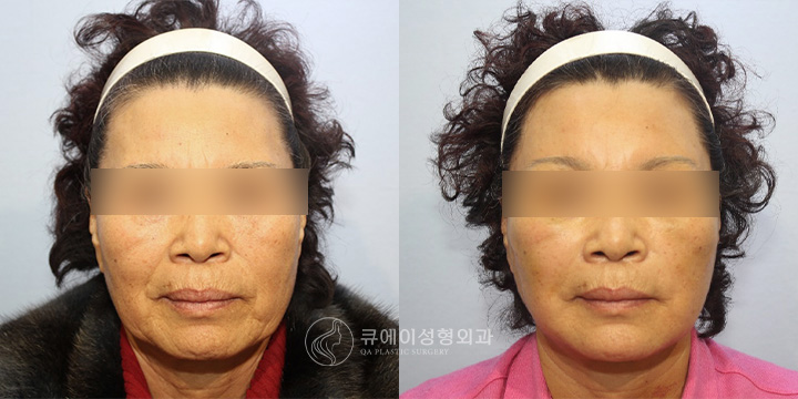 원데이나비리프팅1.jpg