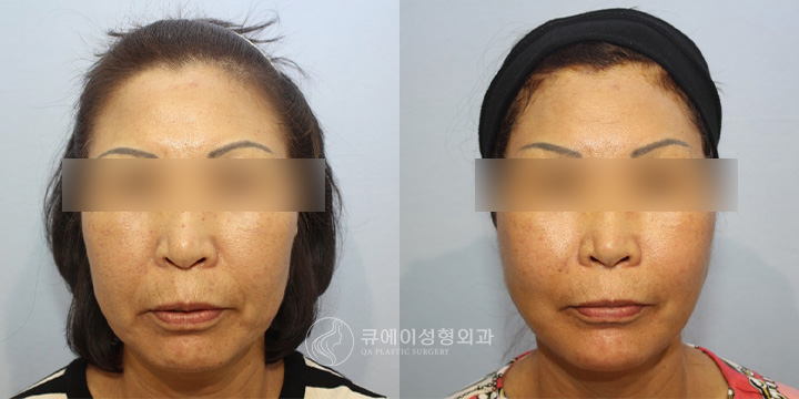 원데이나비리프팅3.jpg