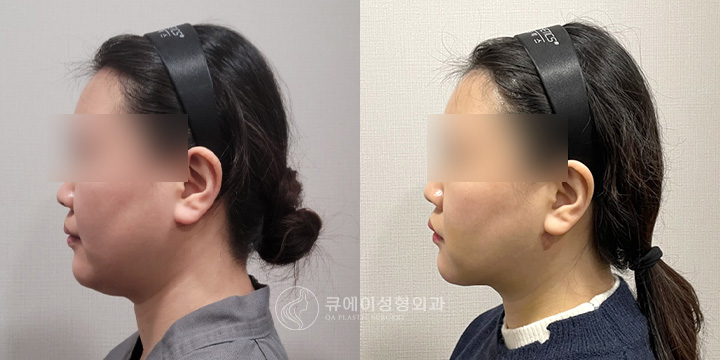이중턱근육묶기4.jpg