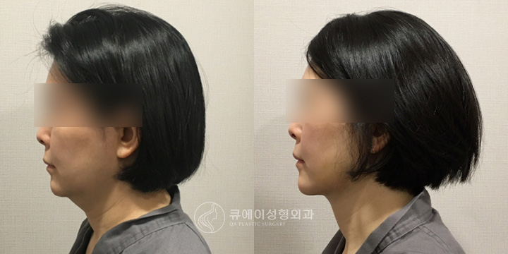 이중턱근육묶기3.jpg