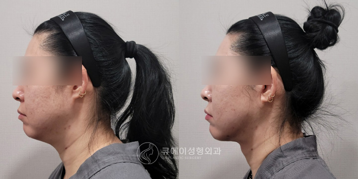 이중턱근육묶기1.jpg