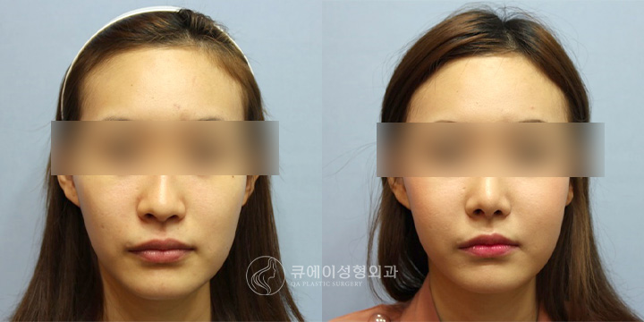 지방이식2.jpg