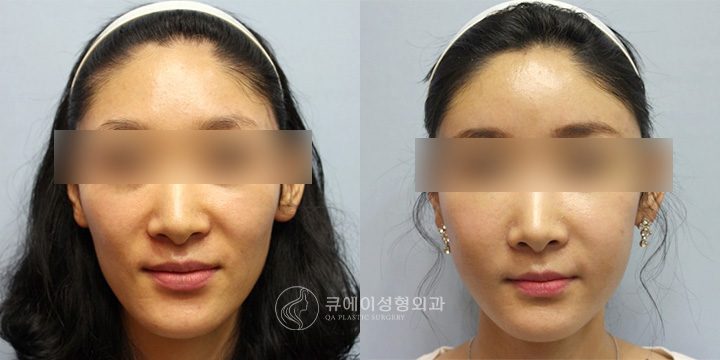 지방이식4.jpg