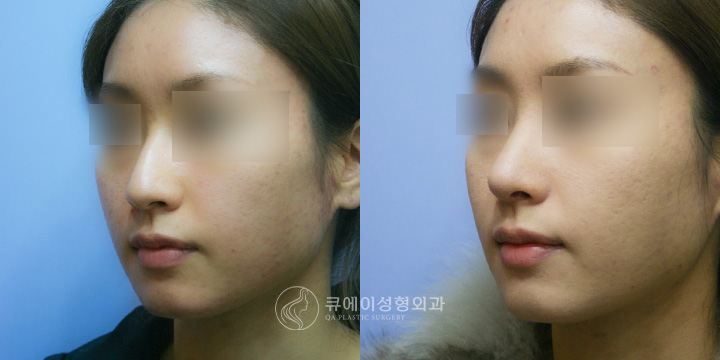 메부리코성형3.jpg