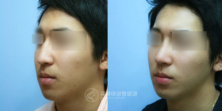 메부리코성형2.jpg