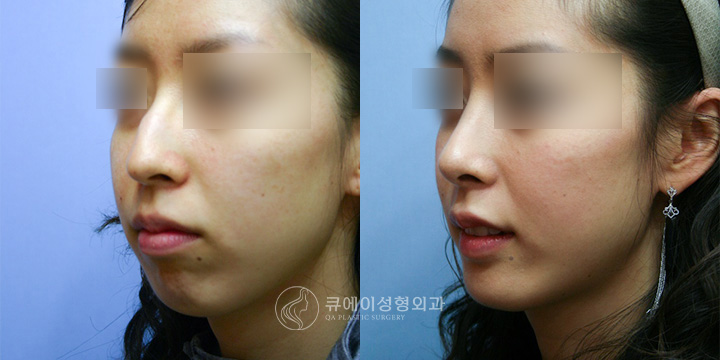 메부리코성형1.jpg