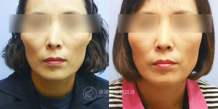휜코교정3.jpg
