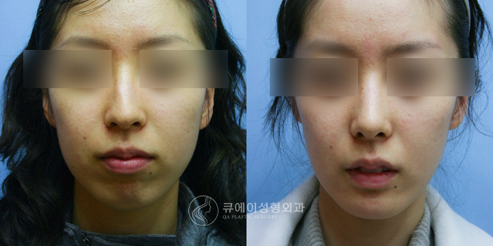 휜코교정2.jpg