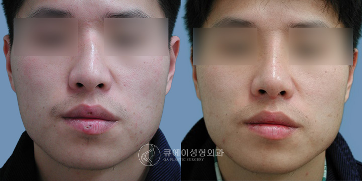 휜코교정1.jpg