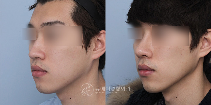 남자코성형2.jpg