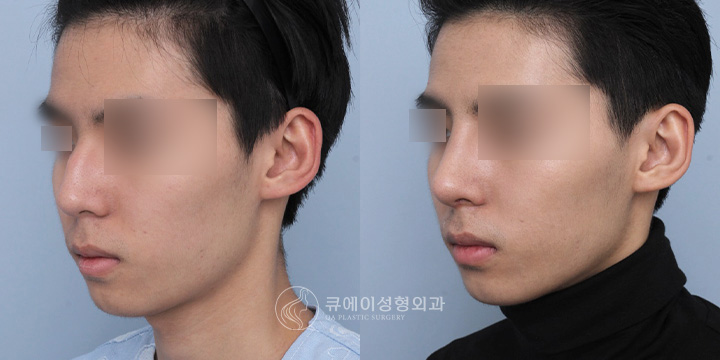 남자코성형1.jpg